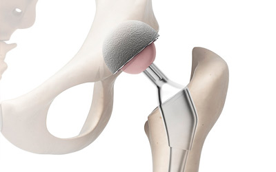 Протез тазобедренного сустава Протез тазобедренного сустава